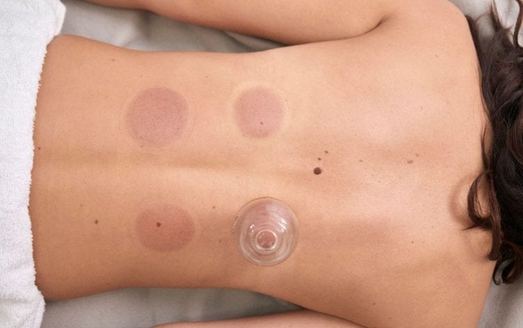 Cupping Is Trending, But Does it Help Recovery?